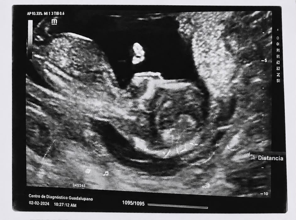Imagen del ultrasonido del bebé